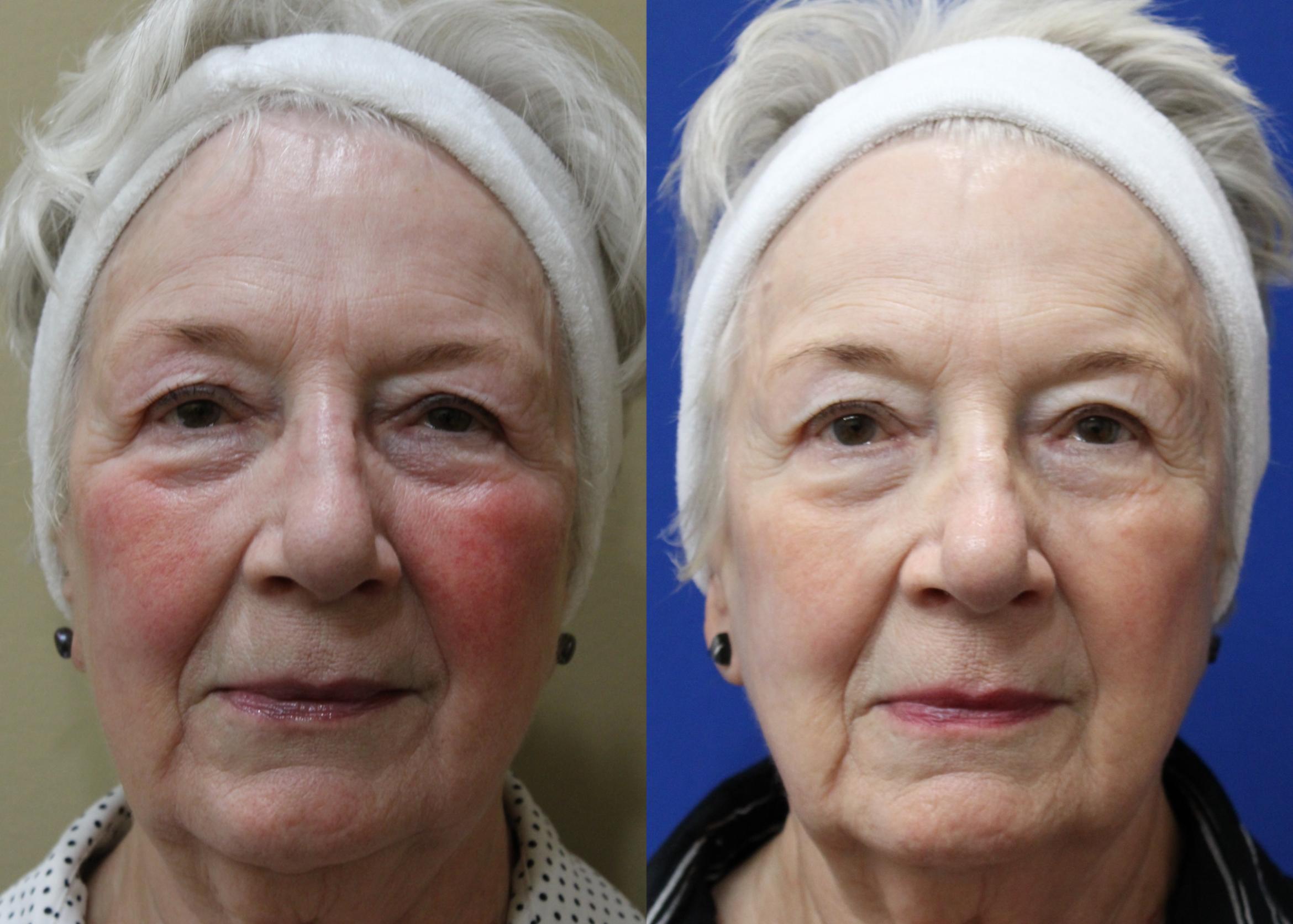 Before & After Aerolase Case 433 Front View in Santa Rosa, California