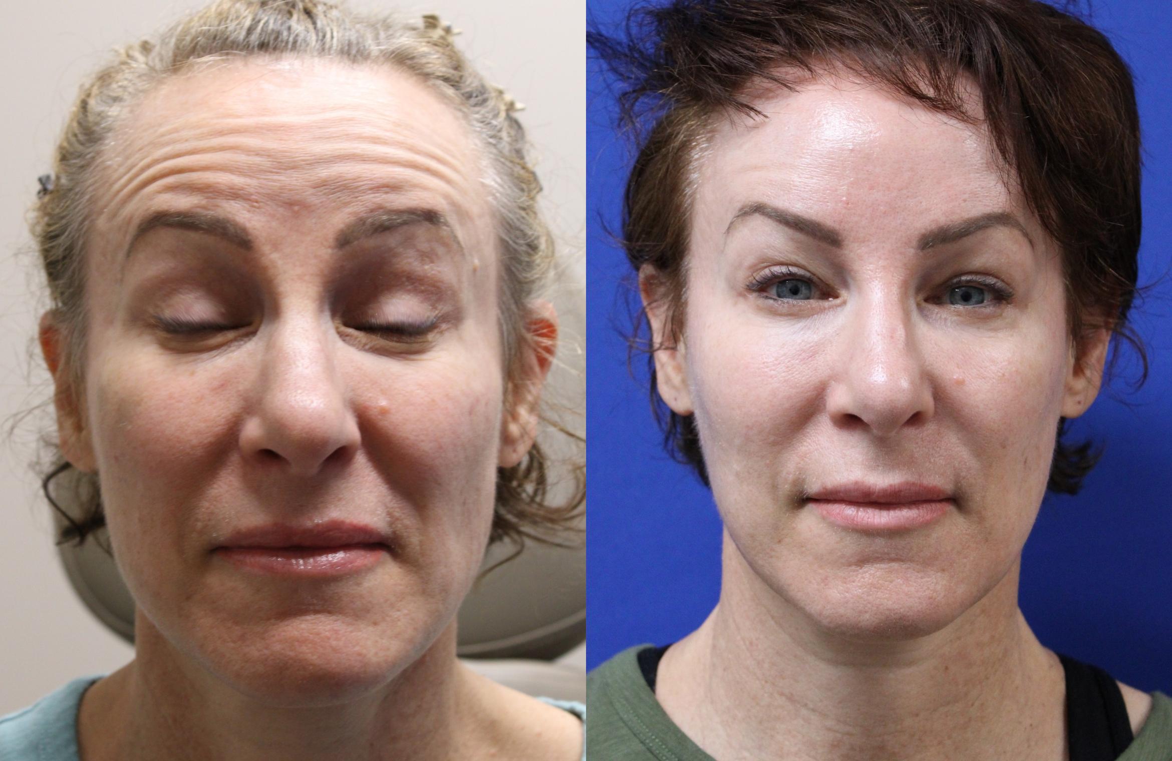 Before & After Botox Case 432 Front View in Santa Rosa, California