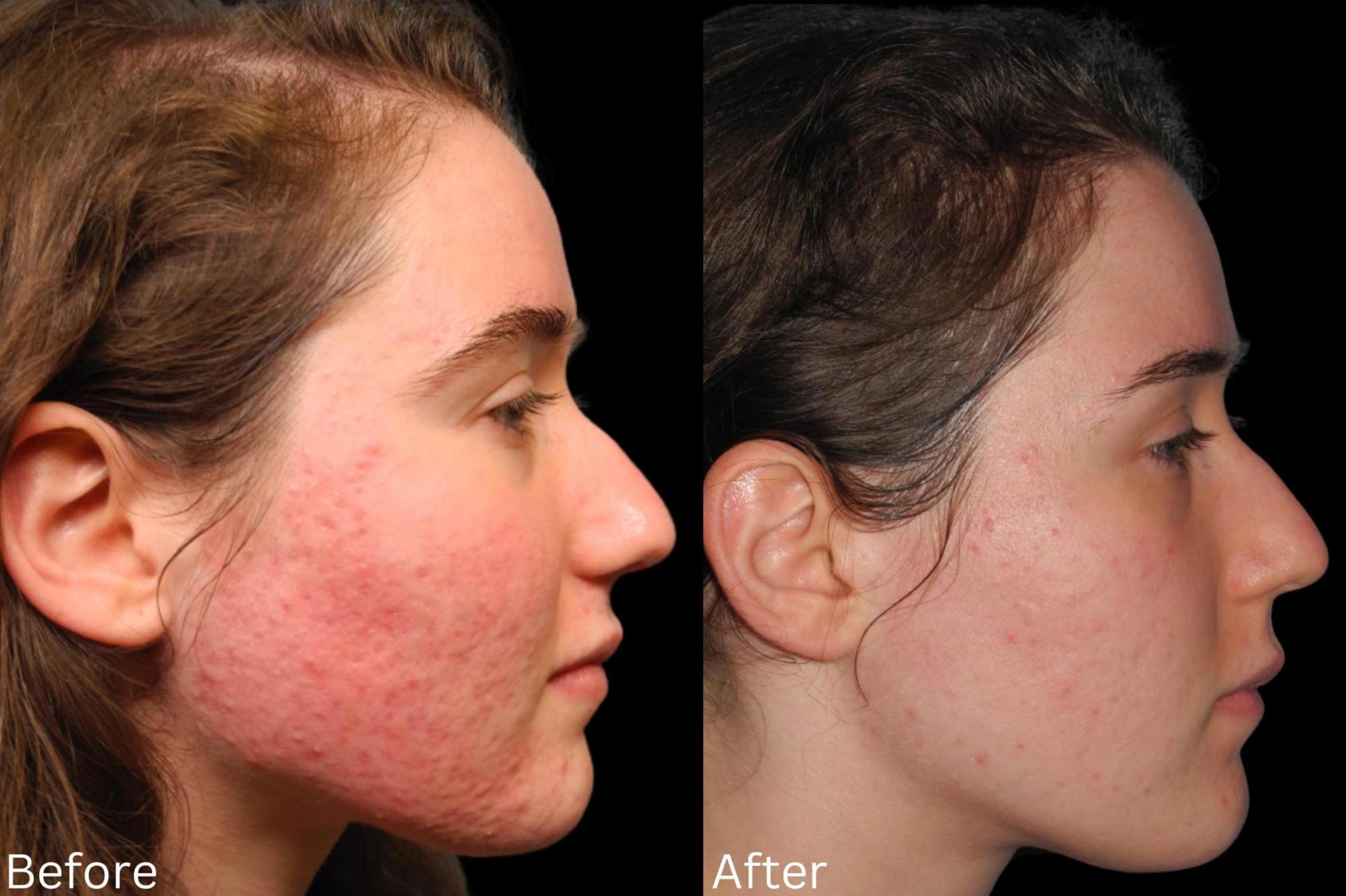 Before & After Acne Treatment Case 115 View 1 View in Santa Rosa, California