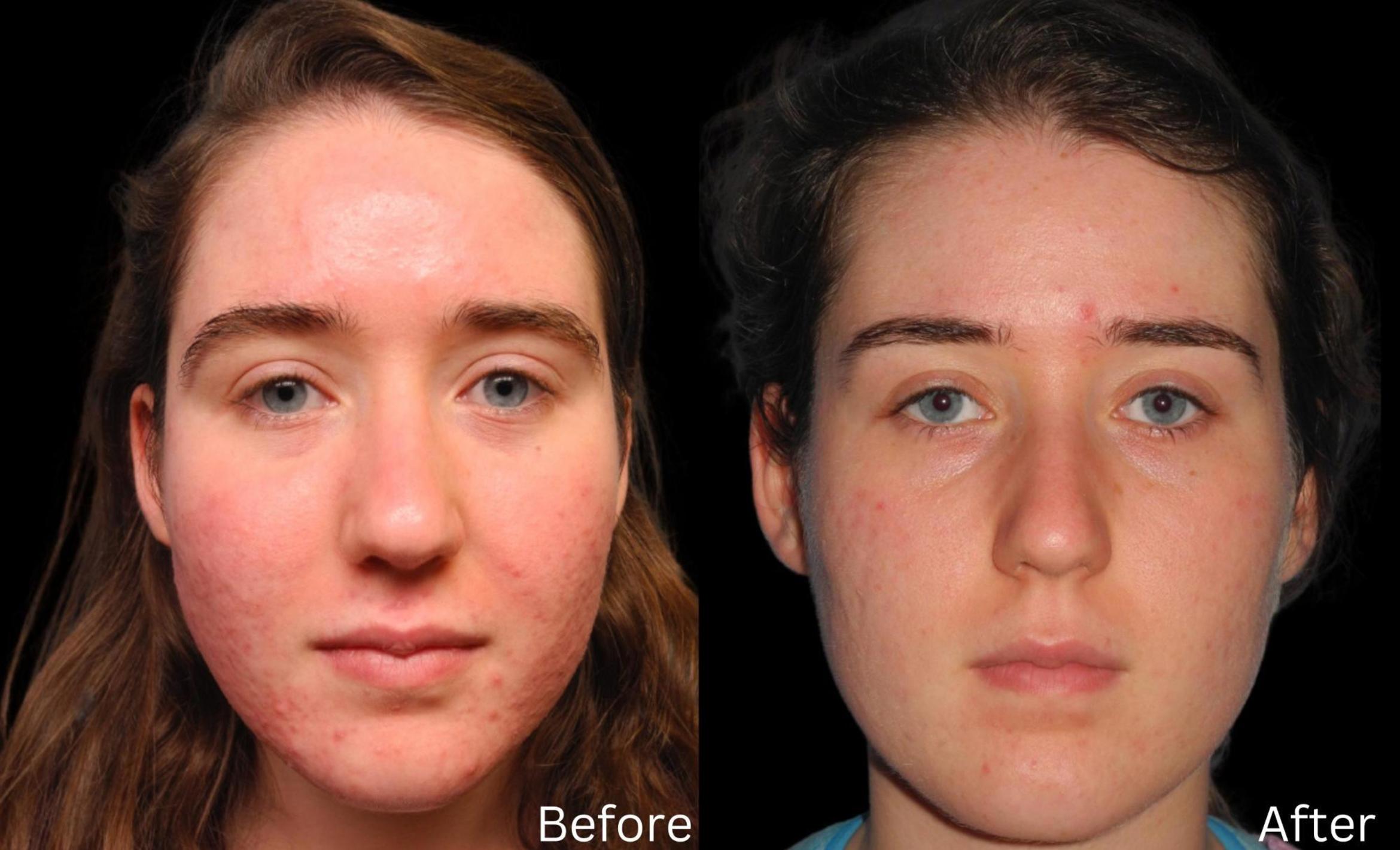Before & After Acne Treatment Case 115 View 2 View in Santa Rosa, California