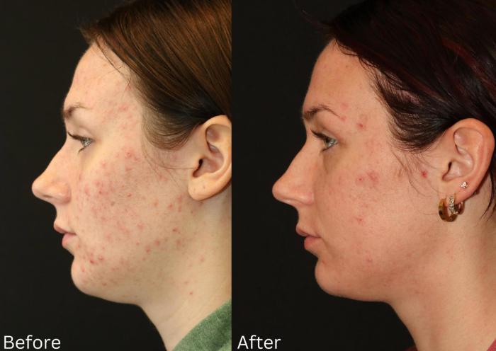 Before & After Acne Treatment Case 116 View 1 View in Santa Rosa, California