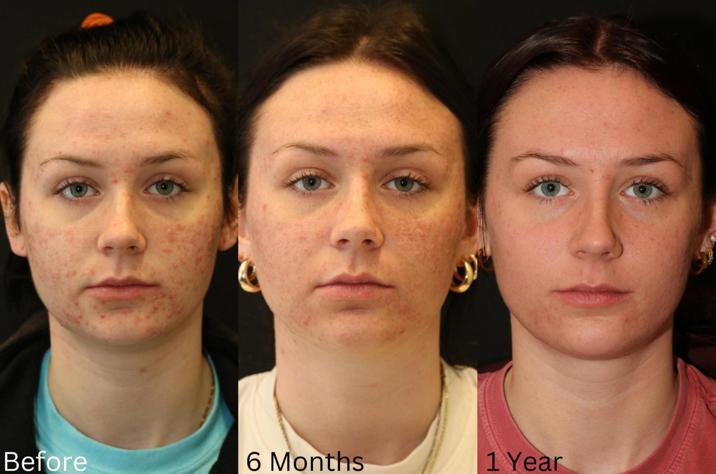 Before & After Acne Treatment Case 116 View 3 View in Santa Rosa, California