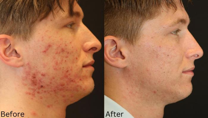 Before & After Acne Treatment Case 117 View 1 View in Santa Rosa, California