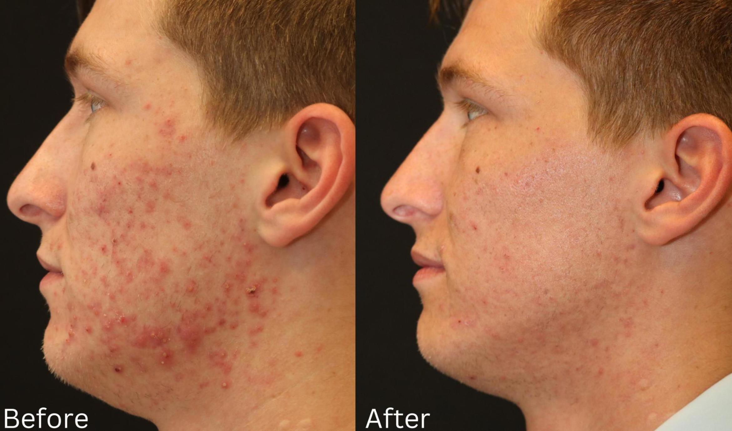 Before & After Acne Treatment Case 117 View 2 View in Santa Rosa, California