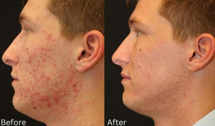 Before & After Acne Treatment Case 117 View 2 View in Santa Rosa, California