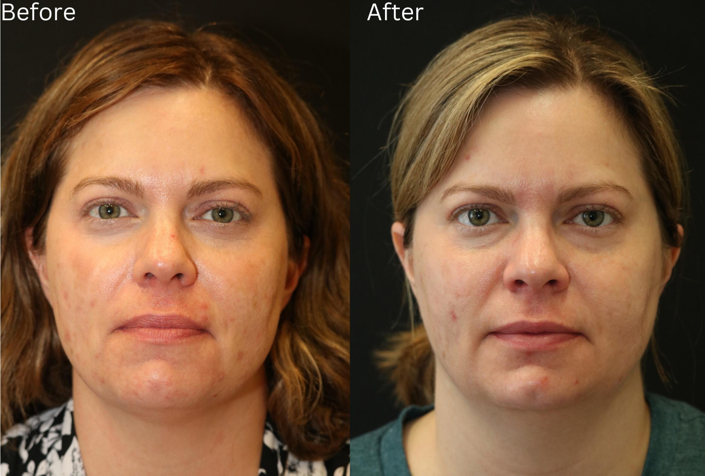 Before & After Acne Treatment Case 230 View 1 View in Santa Rosa, California