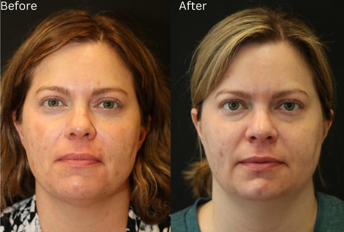 Before & After Acne Treatment Case 230 View 1 View in Santa Rosa, California