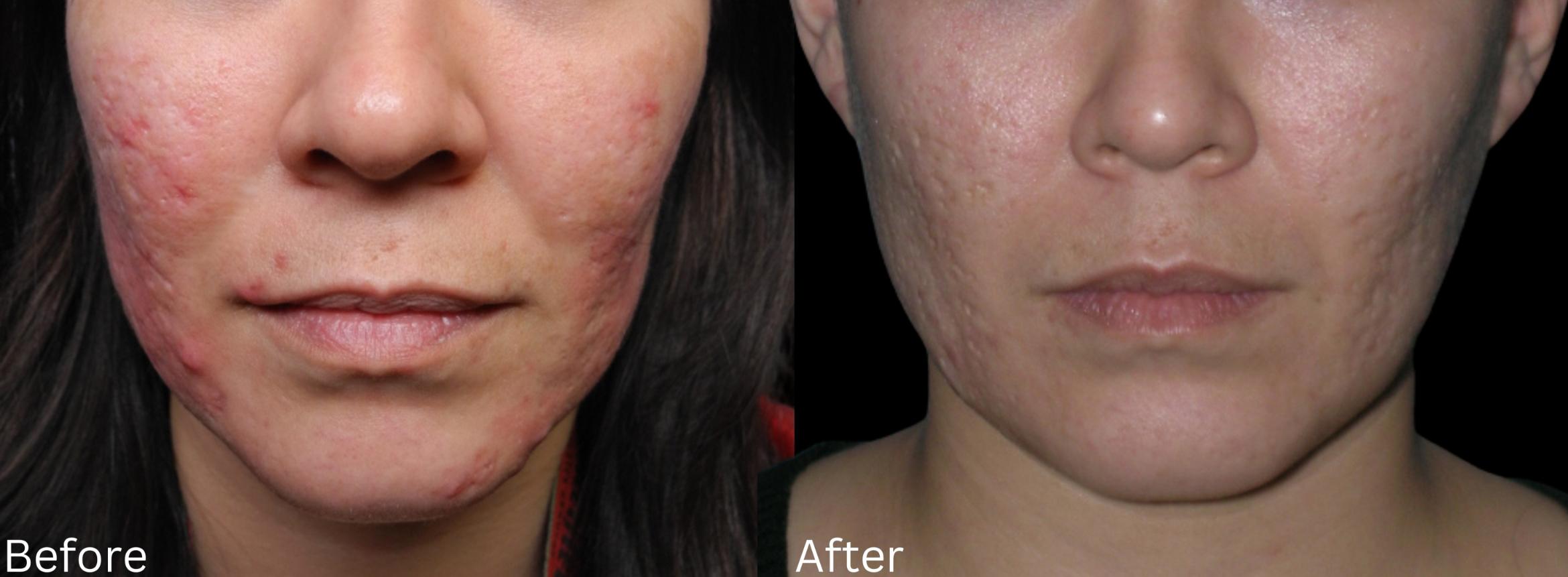 Before & After Acne Treatment Case 231 View 1 View in Santa Rosa, California