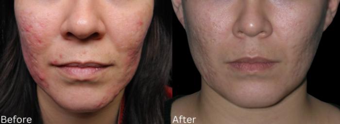 Before & After Acne Treatment Case 231 View 1 View in Santa Rosa, California