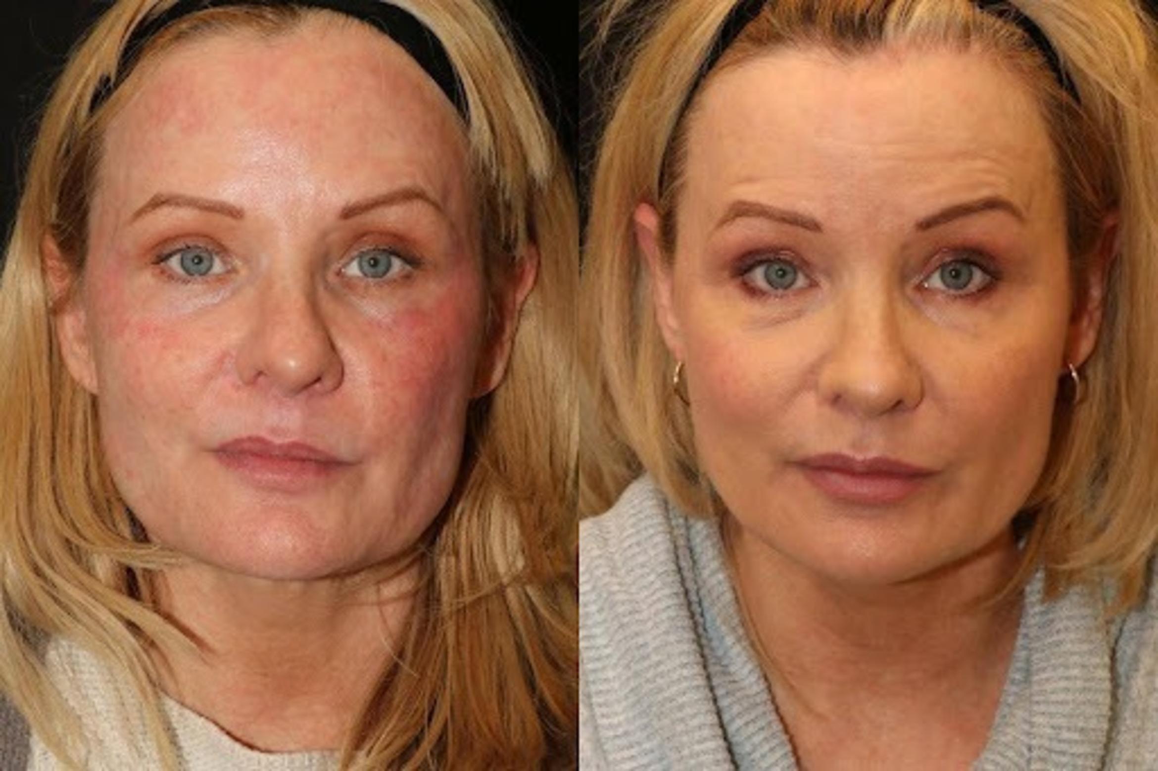 Before & After Aerolase Case 1 View 1 View in Santa Rosa, California
