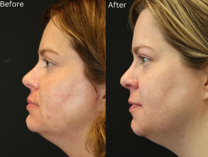 Before & After Aerolase Case 122 View 2 View in Santa Rosa, California