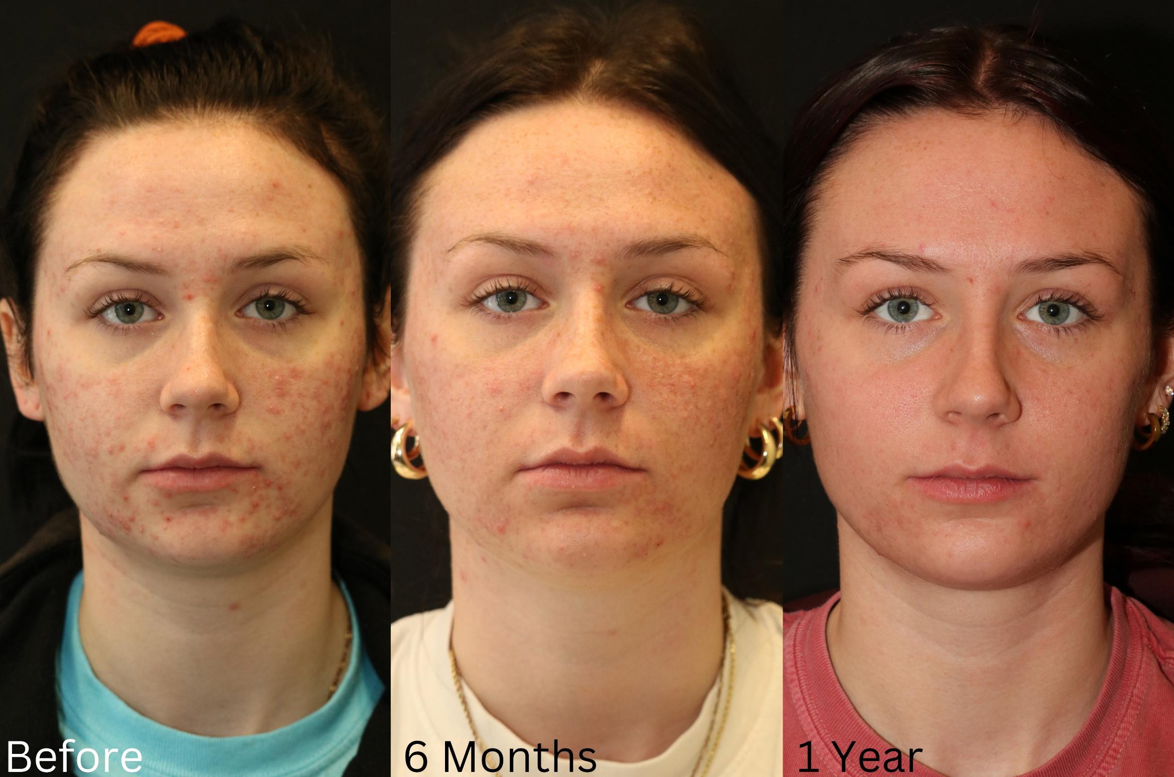 Before & After Aerolase Case 123 View 1 View in Santa Rosa, California