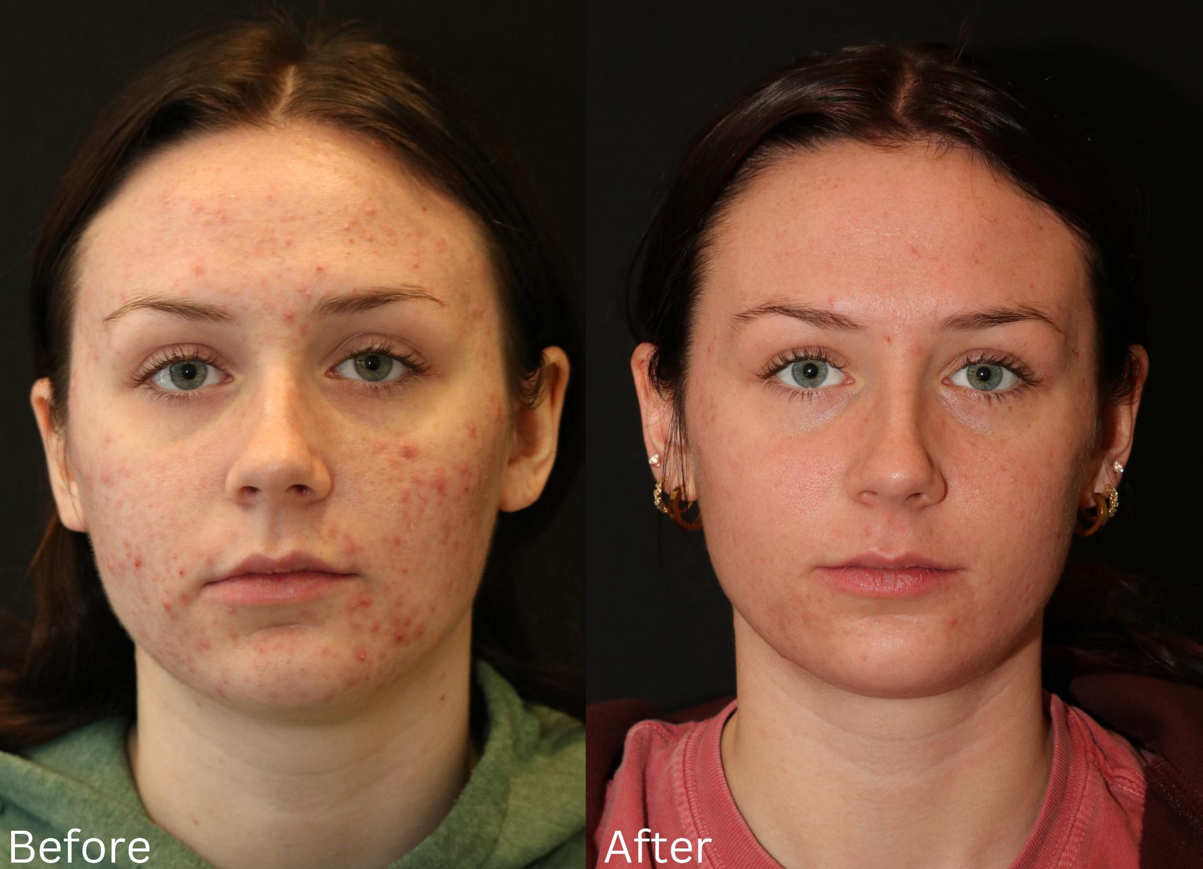 Before & After Aerolase Case 123 View 2 View in Santa Rosa, California