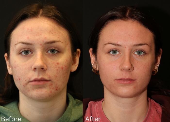 Before & After Aerolase Case 123 View 2 View in Santa Rosa, California