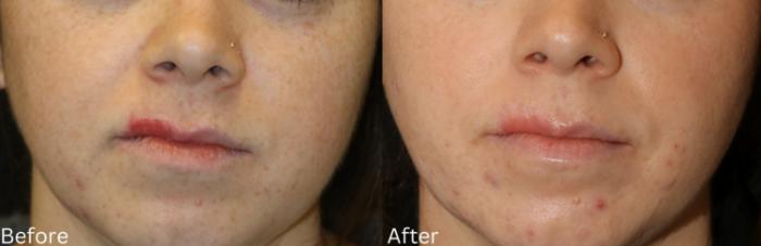 Before & After Aerolase Case 124 View 1 View in Santa Rosa, California