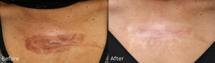 Before & After Aerolase Case 125 View 1 View in Santa Rosa, California