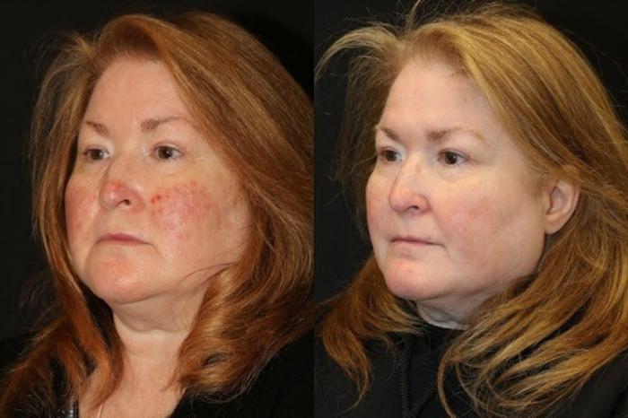 Before & After Aerolase Case 278 View 1 View in Santa Rosa, California