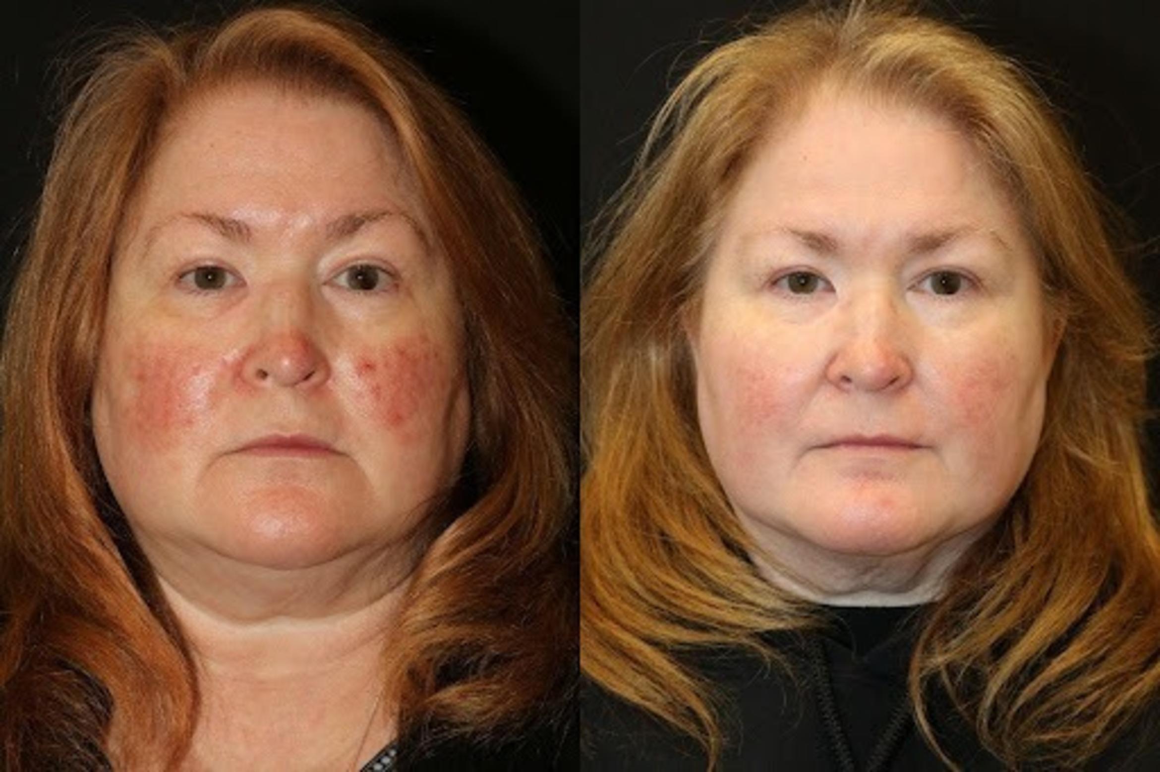 Before & After Aerolase Case 278 View 2 View in Santa Rosa, California