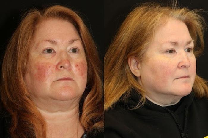 Before & After Aerolase Case 278 View 3 View in Santa Rosa, California