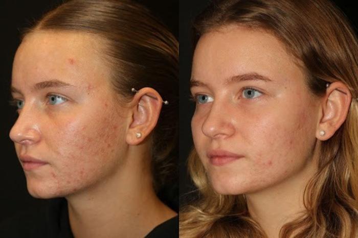 Before & After Aerolase Case 279 View 1 View in Santa Rosa, California