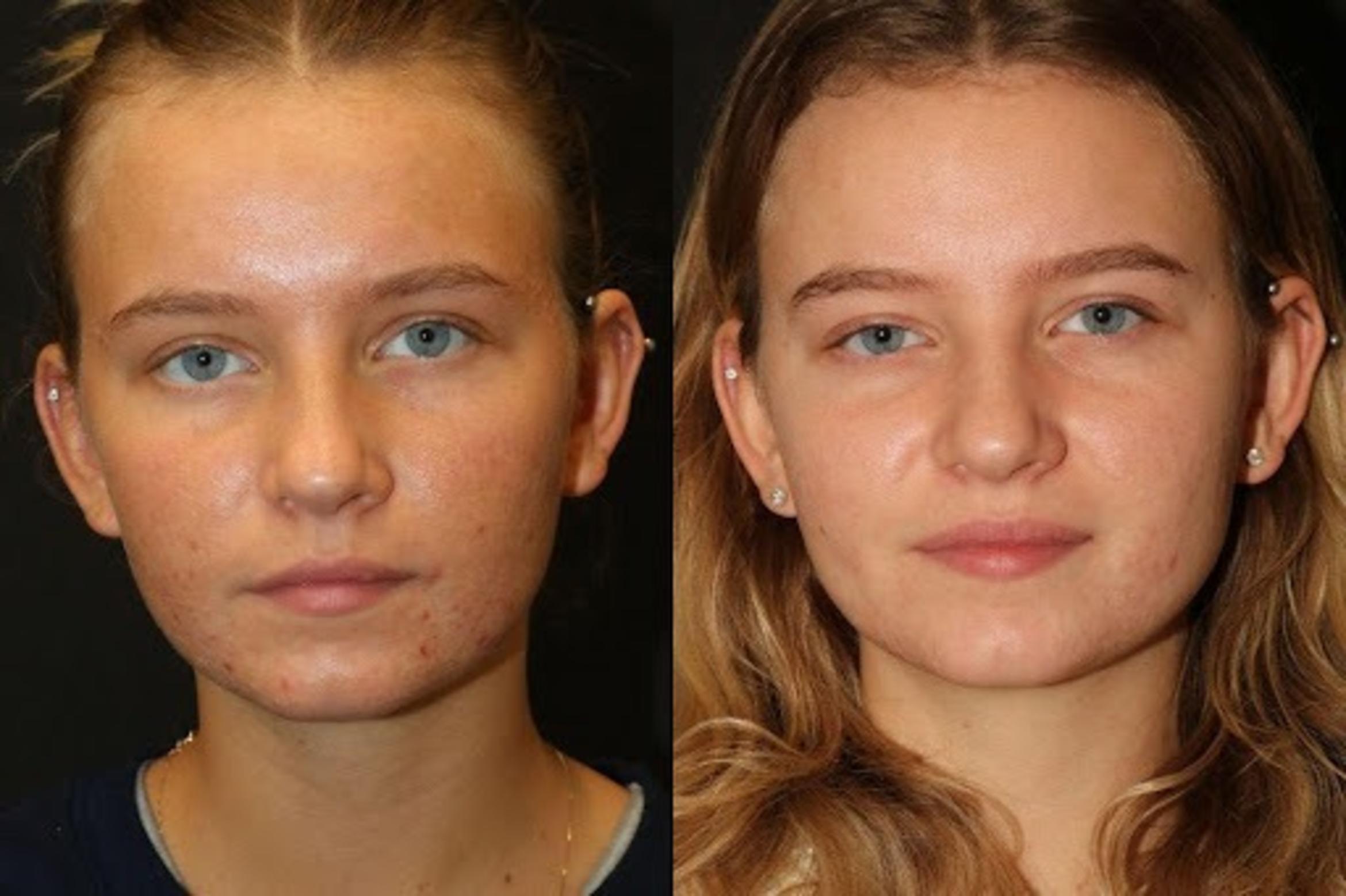 Before & After Aerolase Case 279 View 2 View in Santa Rosa, California