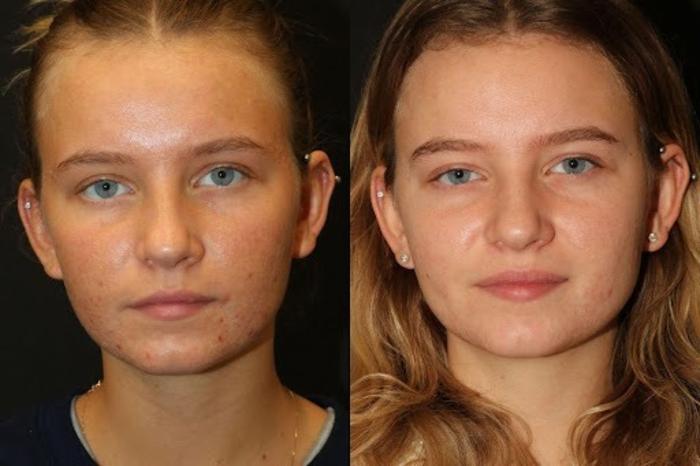 Before & After Aerolase Case 279 View 2 View in Santa Rosa, California