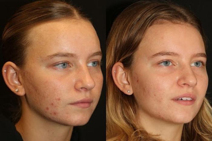 Before & After Aerolase Case 279 View 3 View in Santa Rosa, California