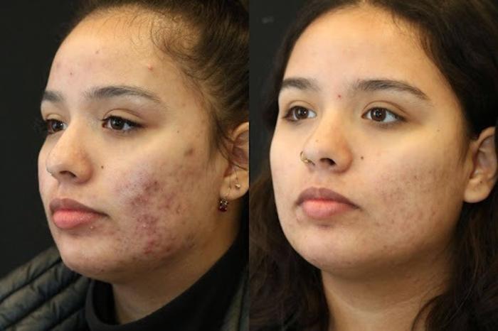 Before & After Aerolase Case 280 View 1 View in Santa Rosa, California