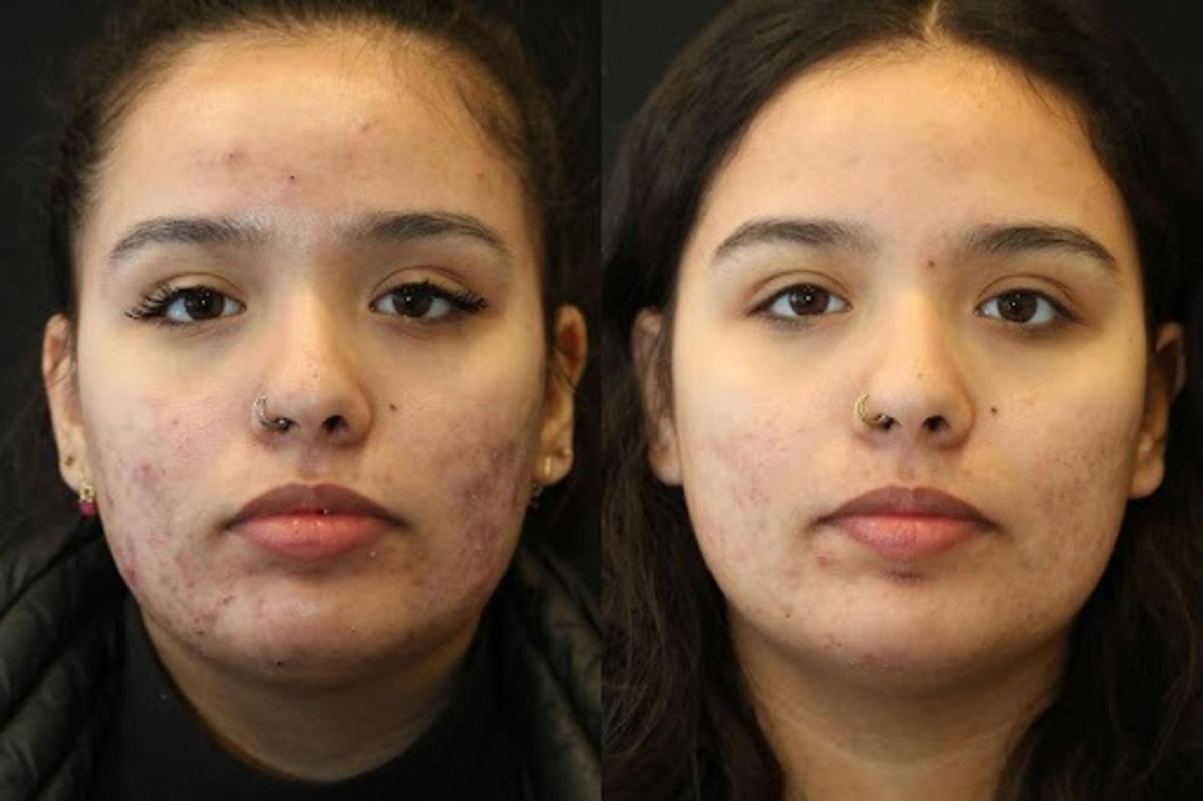 Before & After Aerolase Case 280 View 2 View in Santa Rosa, California