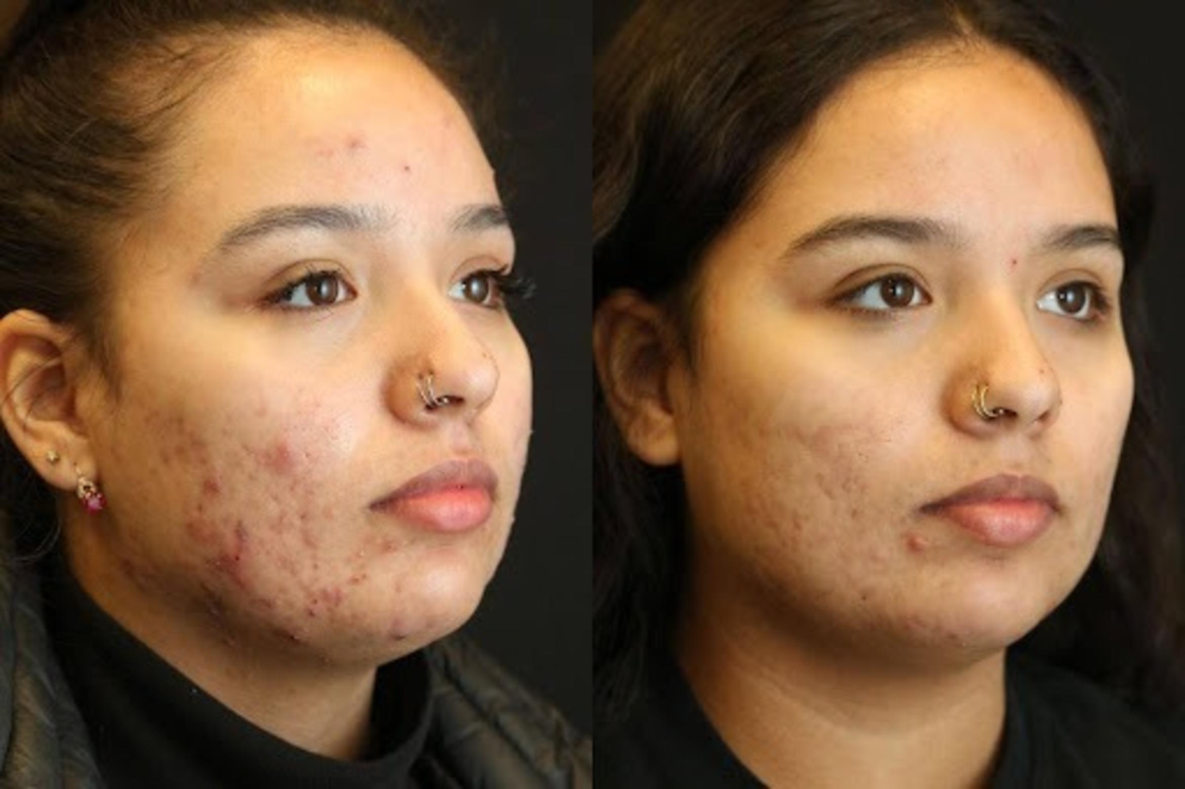 Before & After Aerolase Case 280 View 3 View in Santa Rosa, California