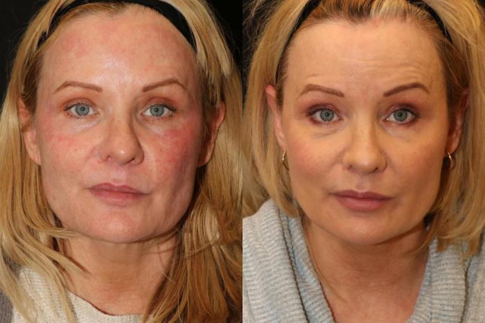 Before & After Aerolase Case 401 View 1 View in Santa Rosa, California