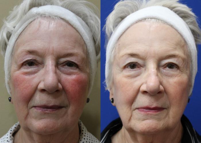 Before & After Aerolase Case 433 Front View in Santa Rosa, California