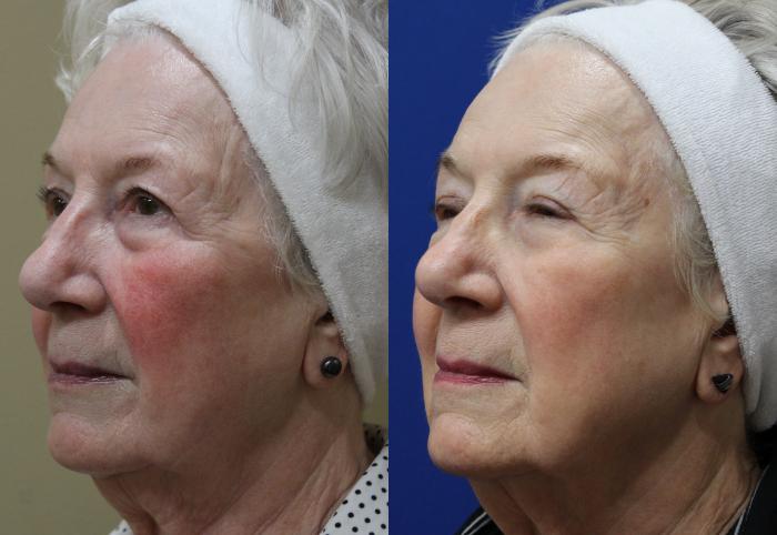 Before & After Aerolase Case 433 Left Side View in Santa Rosa, California