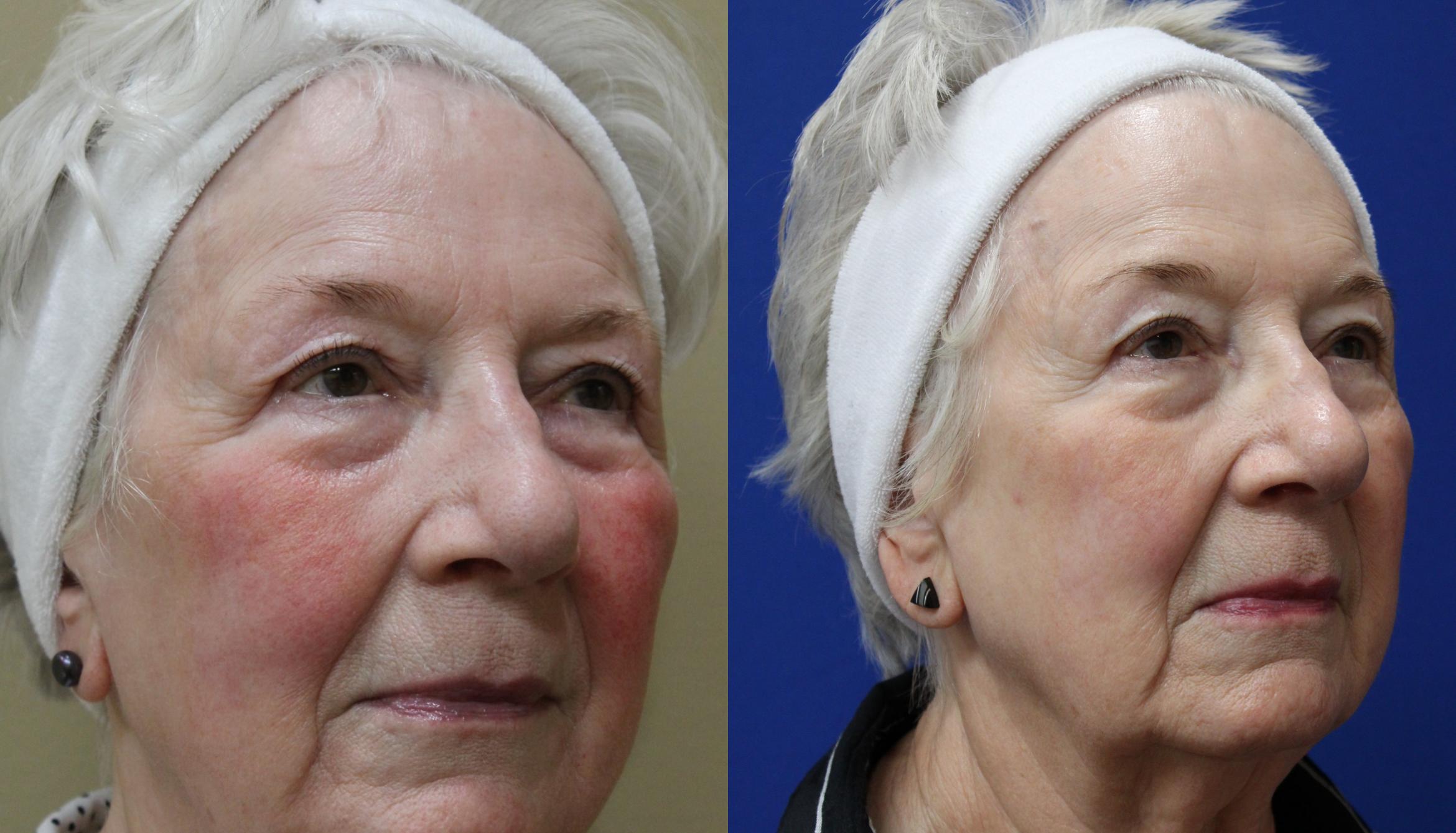 Before & After Aerolase Case 433 Right Side View in Santa Rosa, California