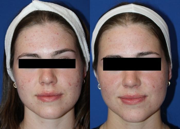 Before & After Aerolase Case 437 Front View in Santa Rosa, California