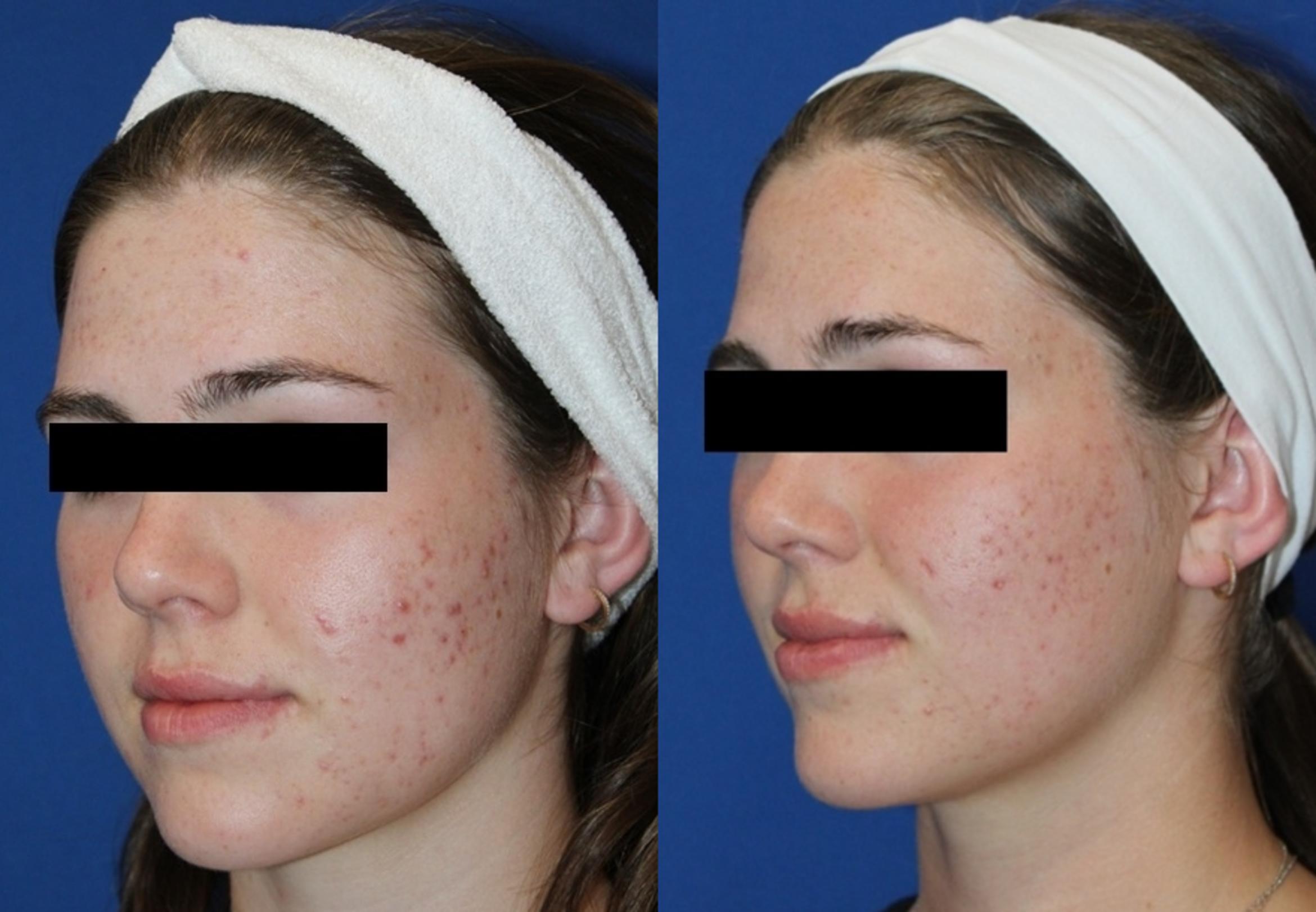 Before & After Aerolase Case 437 Left Oblique View in Santa Rosa, California