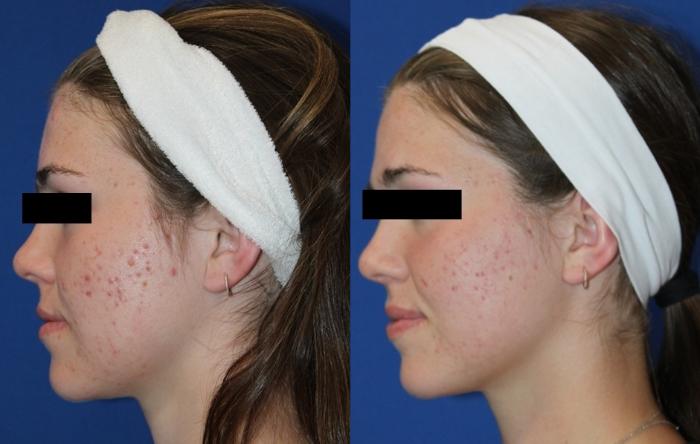 Before & After Aerolase Case 437 Left Side View in Santa Rosa, California