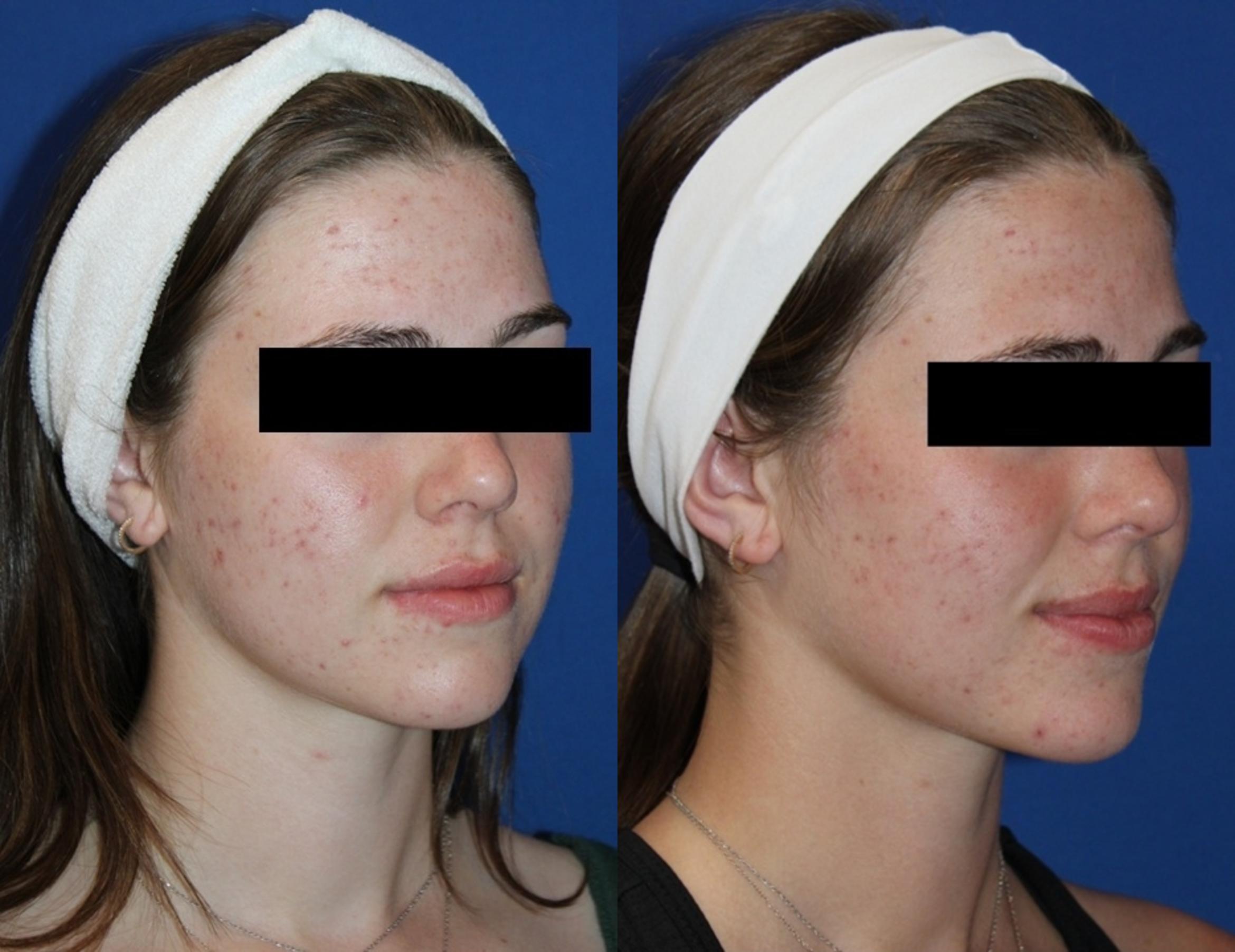 Before & After Aerolase Case 437 Right Oblique View in Santa Rosa, California