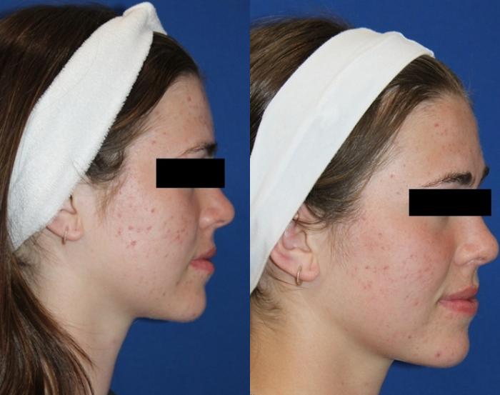 Before & After Aerolase Case 437 Right Side View in Santa Rosa, California