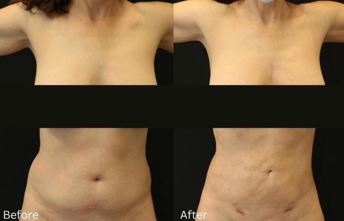 Before & After BodyTite Case 118 View 1 View in Santa Rosa, California