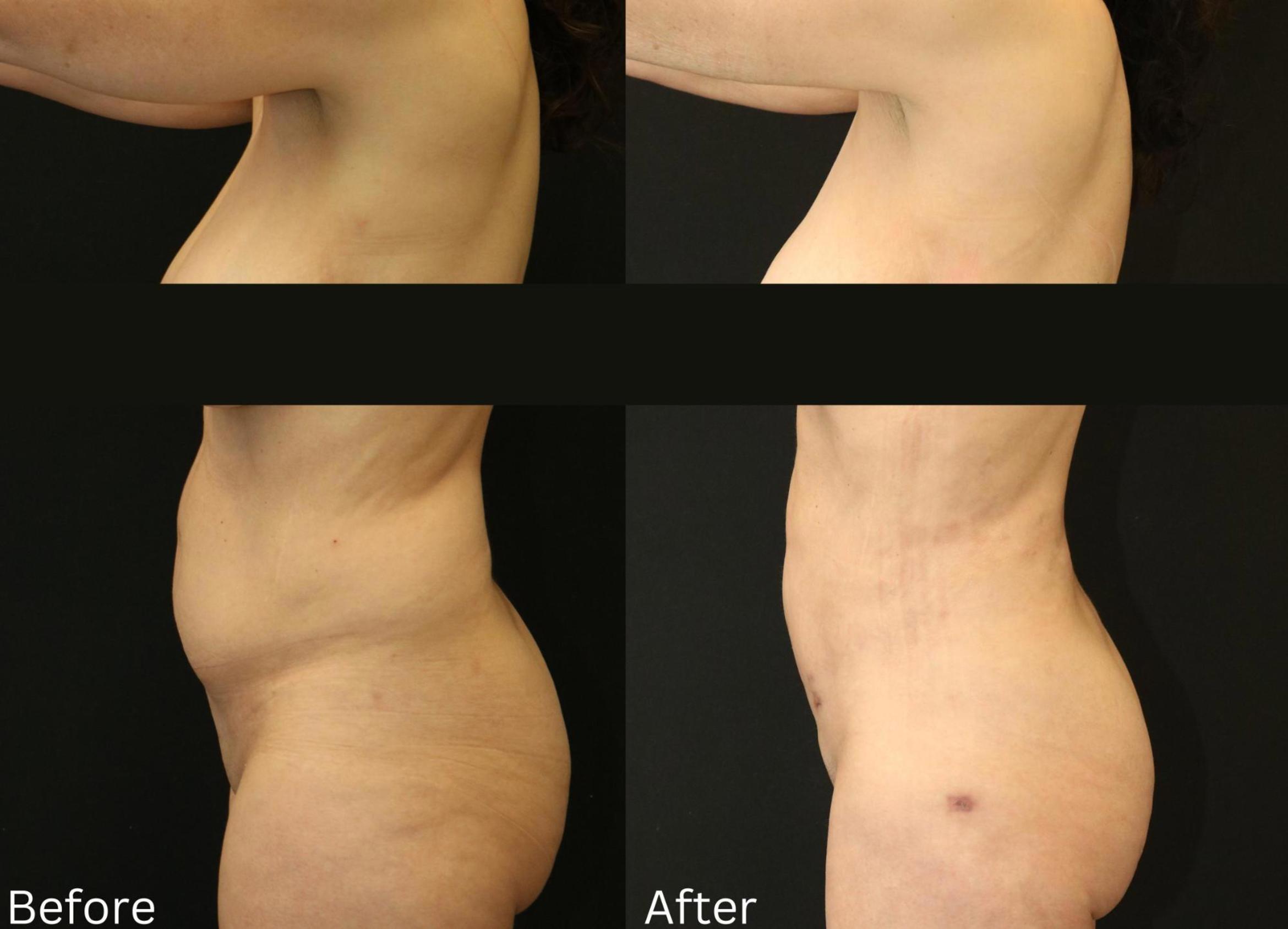 Before & After BodyTite Case 118 View 2 View in Santa Rosa, California
