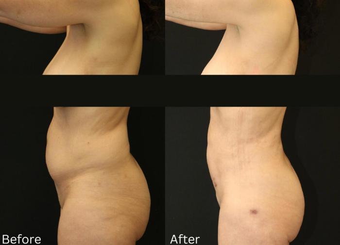 Before & After BodyTite Case 118 View 2 View in Santa Rosa, California