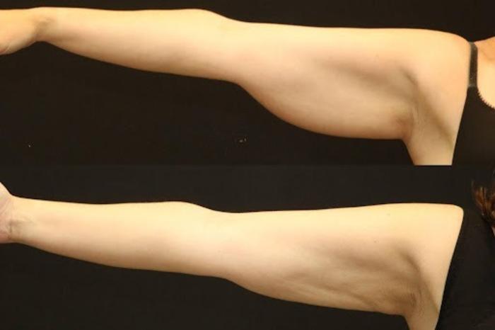 Before & After BodyTite Case 270 View 1 View in Santa Rosa, California