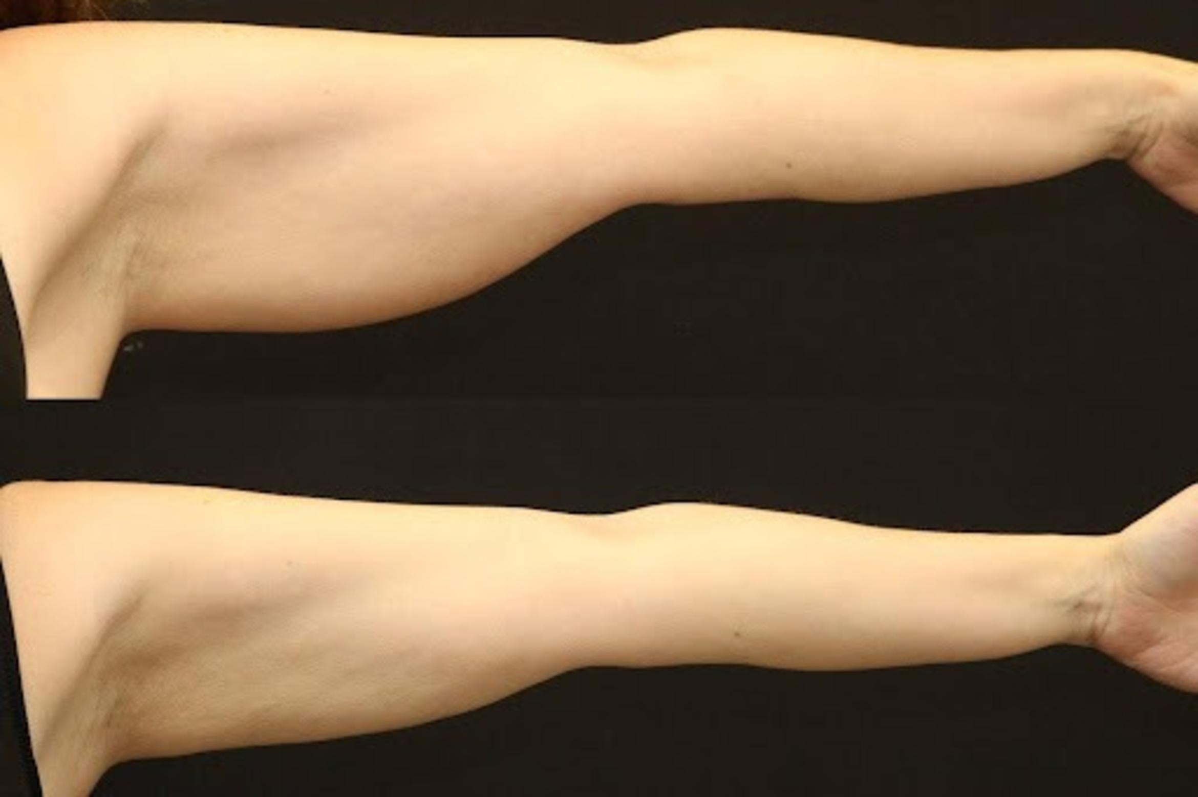 Before & After BodyTite Case 270 View 2 View in Santa Rosa, California