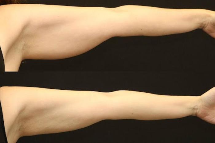 Before & After BodyTite Case 270 View 2 View in Santa Rosa, California