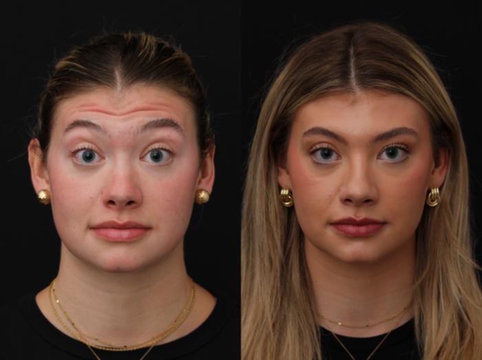 Before & After Botox Case 416 Front View in Santa Rosa, California