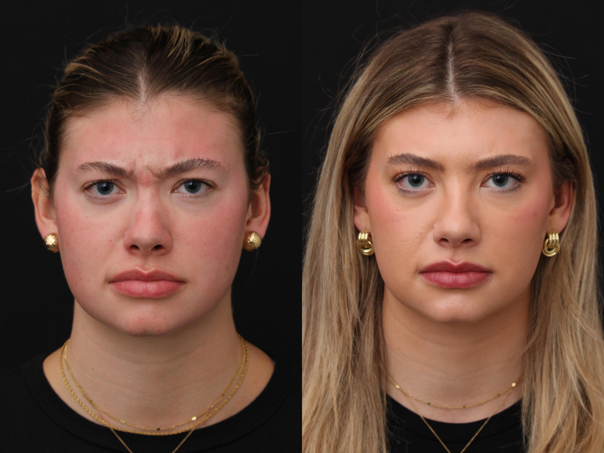 Before & After Botox Case 416 View 2 View in Santa Rosa, California