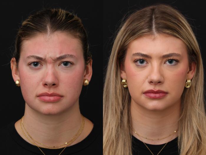 Before & After Botox Case 416 View 2 View in Santa Rosa, California