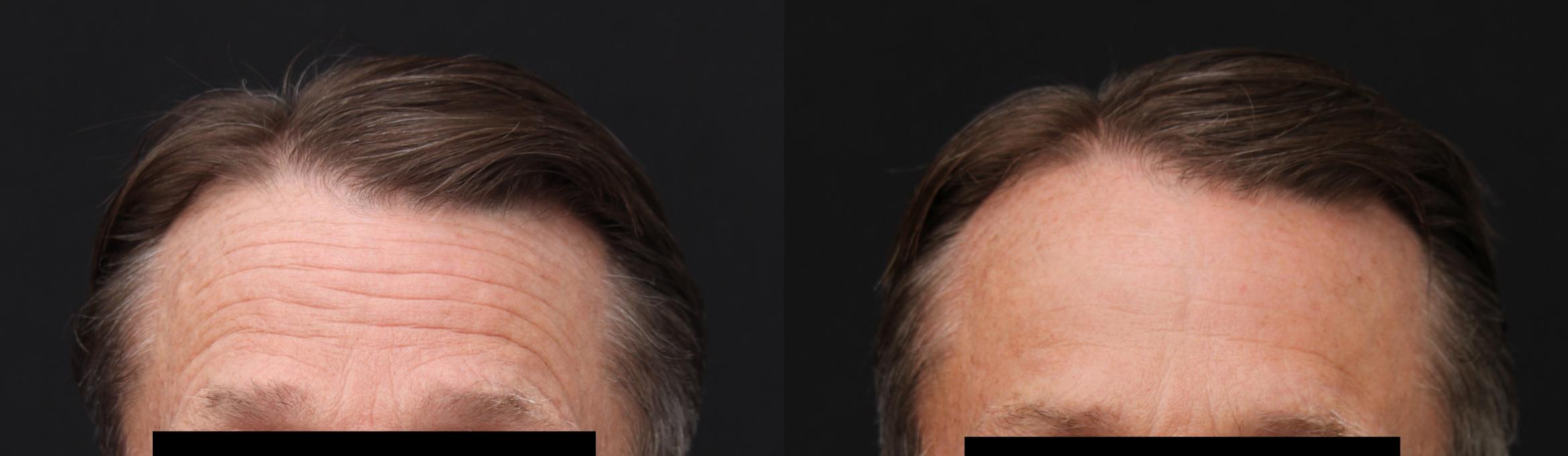 Before & After Botox Case 419 Front View in Santa Rosa, California