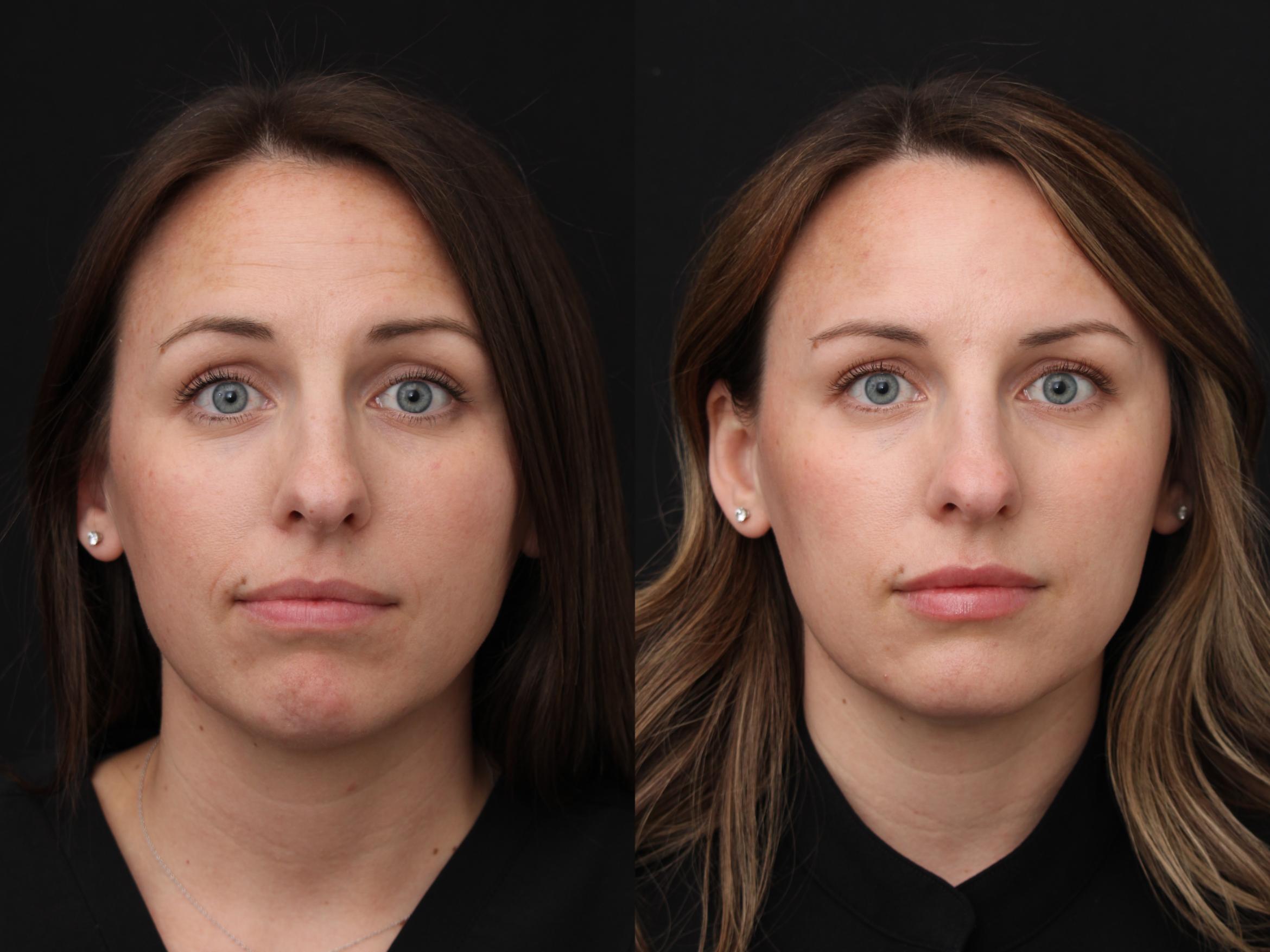 Before & After Botox Case 420 Front View in Santa Rosa, California